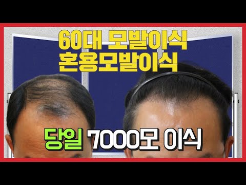 모발이식 10년은 젊어보입니다. 7000모  절개식과 비절개식 두가지를 함께 혼용하여 당일 젊음을 찾아 드립니다.