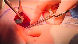 Post-Ravitch Repair of Recurrent Pectus Excavatum with Minimally Invasive Anatomik Modelling Implant