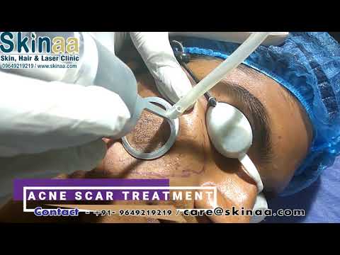 Acne Scar Laser Removal Treatment in Jaipur with Fractional Co2 FDA Approved Laser| Skinaa Clinic