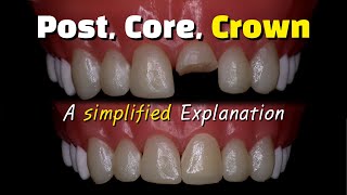 Fixing a broken front tooth with a post, core buildup and crown (after a root canal..)