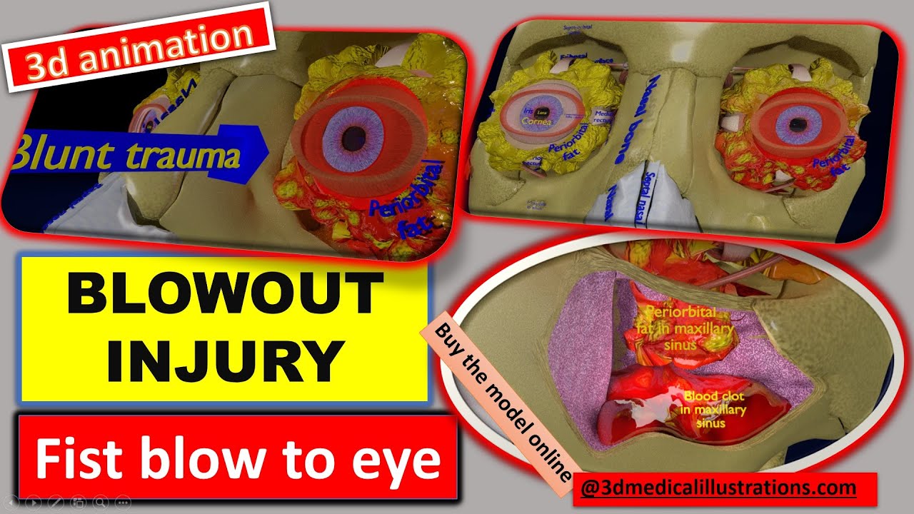 Eye blow out injury 3d 3D Model