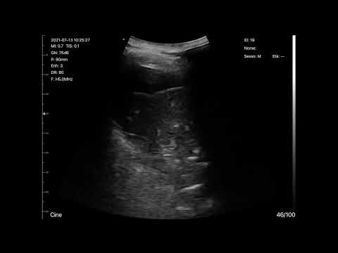 BEDSIDE ULTRASOUND WITH CERBERO ATL Wireless Ultrasound Probe - ACUTE PNEUMONIA