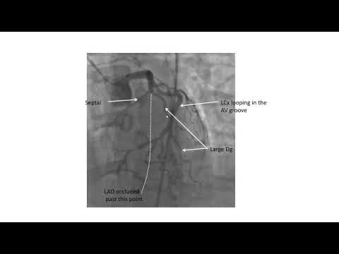 Coronary angiographic views- Elias Hanna