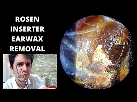 Rosen Inserter Used to Remove Hard Adhered Ear Wax (Techniques Explained)