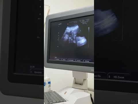 19 weeks pregnant anatomy scan