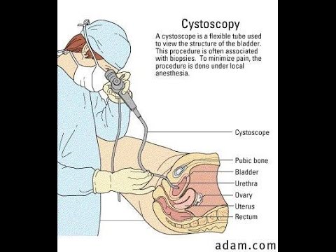 Video Cystoscopy Actual Procedure [ENG SUB]