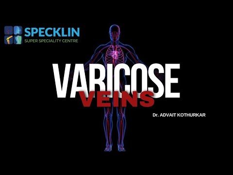 UNLOCKING EFFECTIVE VARICOSE VEINS TREATMENTS: DISCOVER SOLUTIONS FOR HEALTHIER LEGS.