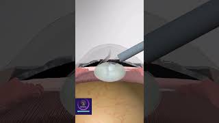 Cataract Surgery - 3D Animation