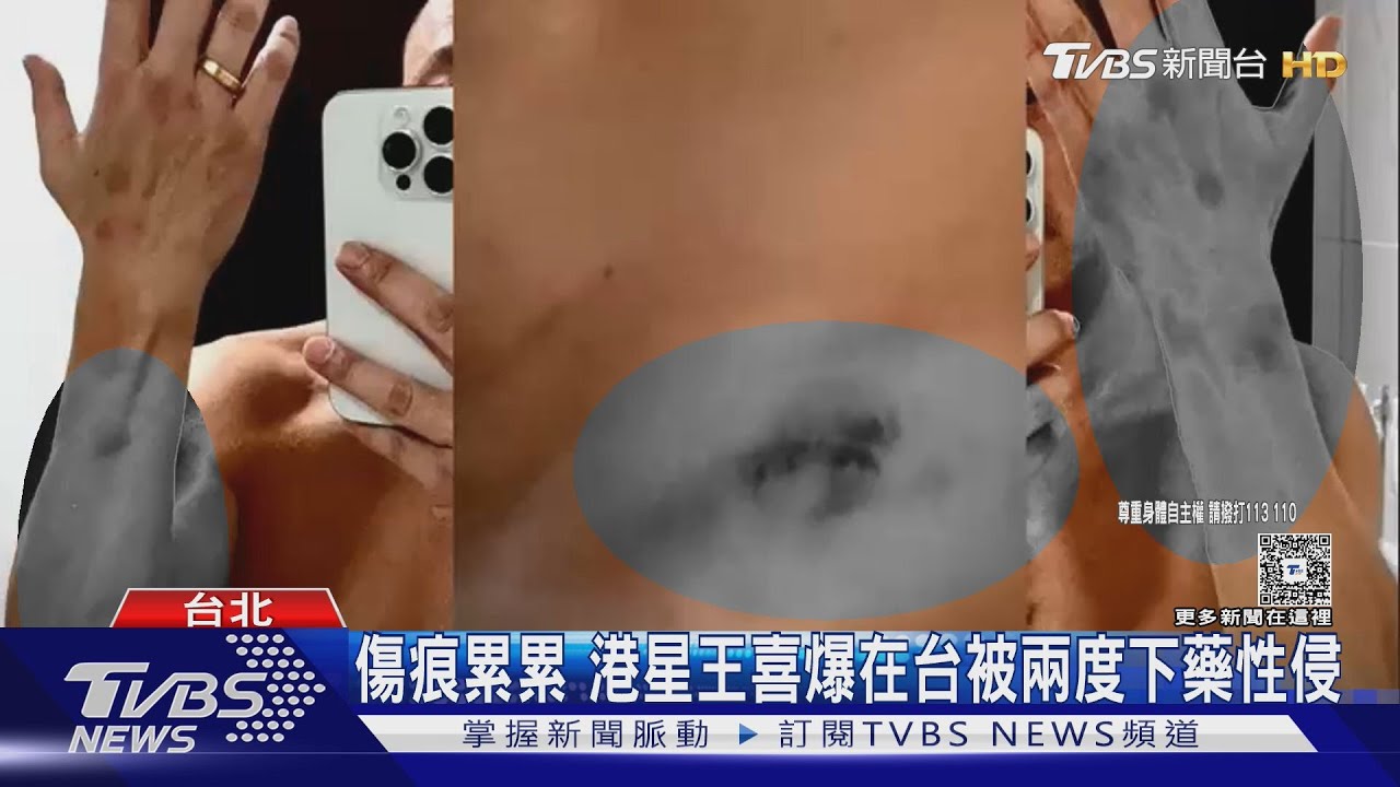 公開傷勢照! 港男星自爆在台被二度下藥性侵 健康重創差點洗腎
