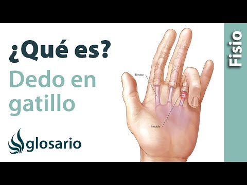 DEDO EN GATILLO O EN RESORTE | ¿Qué es?