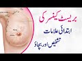 Breast Cancer Symptoms Causes And Treatment Breast Cancer Ki Alamat Aur Ilaj MedHealth Urdu