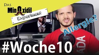 Das Minoxidil Experiment #Woche10 Minoxidil STOPP plötzlich allergisch?
