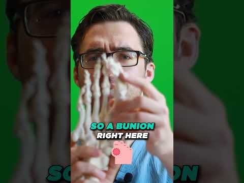 What Causes Bunions What is a bunion How Do You Get Bunions