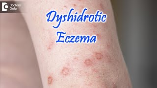 Dyshidrotic Eczema ( POMPHOLYX ) : Causes, Symptoms, & Treatment - Dr. Nischal K | Doctors