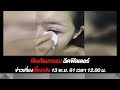 ฉีด ฟิลเลอร์ ปาก