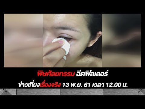 ฉีด ฟิลเลอร์ ปาก
