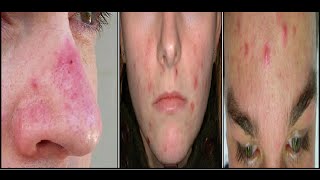 How to get rid of Zits on face, nose, forehead fast overnight