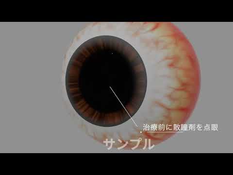 ICL手術