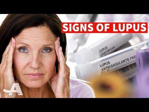 5 Early Signs of Lupus