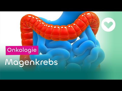 Magenkrebs - Magenspiegelung, Symptome und Chemotherapie