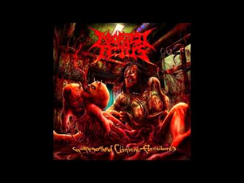 Aborted Fetus - Goresoaked Clinical Accidents [FULL ALBUM]