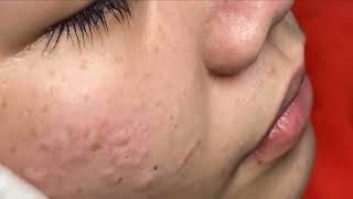 Remove blackheads simply with tweezers 2