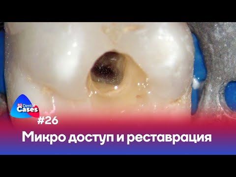 Микро доступ и реставрация. Пошагово | Дентал Кейсы от BG #26