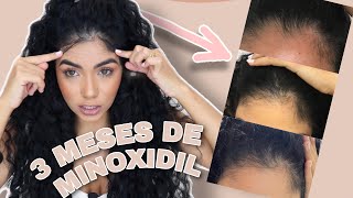 EFEITOS COLATERAIS DO MINOXIDIL | Depois de 3 meses de uso