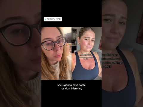 Burn From An IPL #shorts