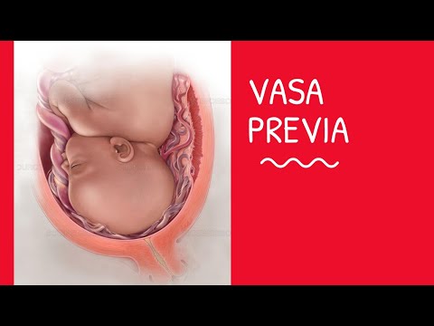 VASA PREVIA (Unit-8 OBG- Abnormal Labour)