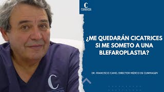 ¿Me quedarán cicatrices si me someto a una blefaroplastia o a una cirugía de párpados