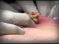 BIGGEST CYST ON THE PLANET | Operation "Kill ...