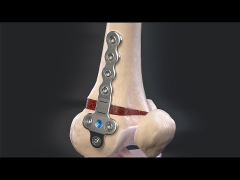 Distal Femoral Osteotomy