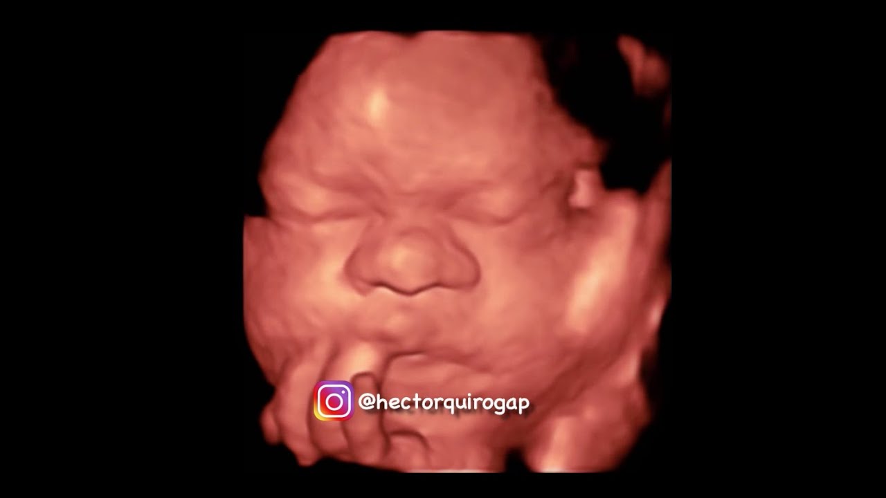 Watch Síndrome de Down. Signos ecográficos típicos. Now Síndrome de Down. Signos ecográficos típicos.