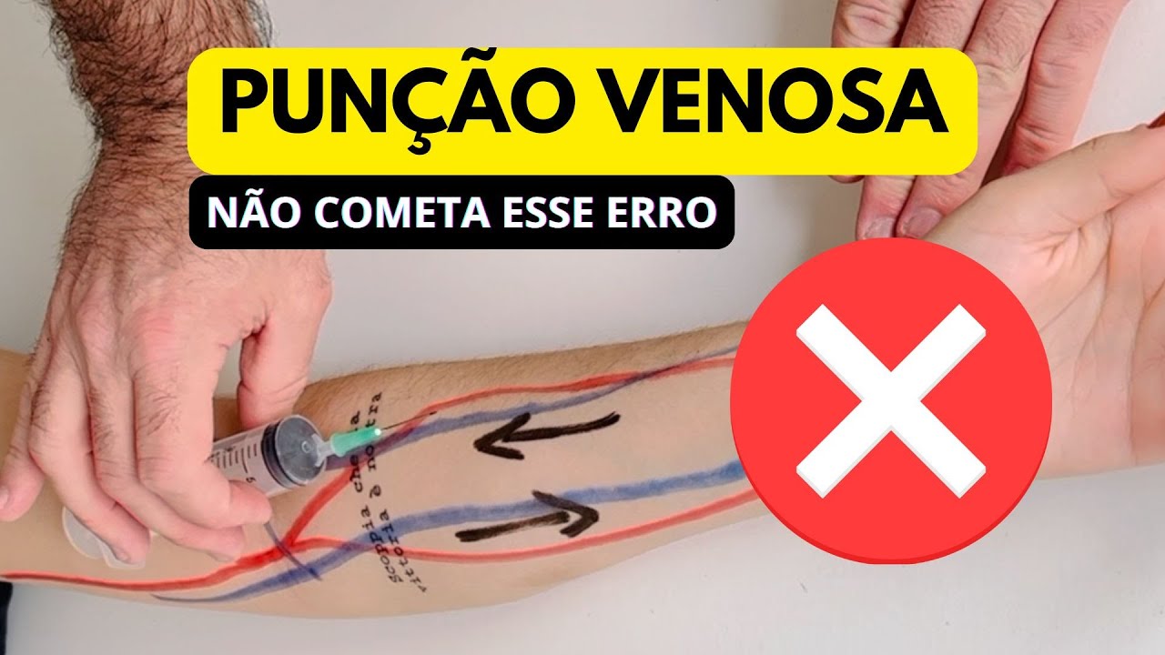 🎥 Aprenda o Posicionamento Correto do Cateter Venoso 💉