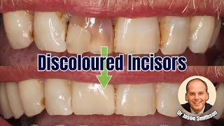 Discoloured Central Incisors with Jason Smithson - PDP191
