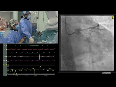Optimising treatment for patients with severe calcified lesions: the role of orbital atherectomy