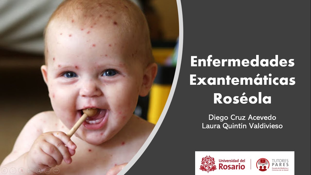 Exanthematous Diseases: Roseola or Exanthema Subitum