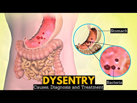 , title : 'What is Dysentery? Causes, Signs and symptoms, Diagnosis and treatment.'