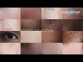 The Biggest Pigmentation Innovation: La Roche-Posay MELA B3 Serum