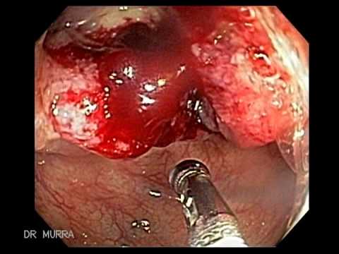 Operatie cancer de col uterin pret