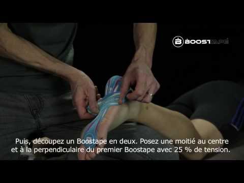 comment soulager syndrome de morton