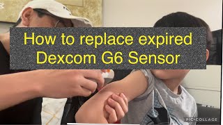 How replace Dexcom G6 sensor #Type1diabetes #DexcomG6  #diabetes #diabetesawareness