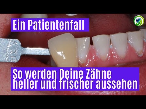 So werden deine #Zähneheller | #schöneweißeZähne - #Zahnaufhellung - Zahnbleaching