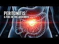 2 4 3 1 Spontaneous Bacterial Peritonitis SBP Fire In The Abdomen