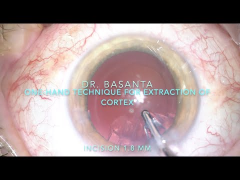One hand cataract cortex extraction