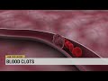 Ask The Expert The Warning Signs Of Blood Clots