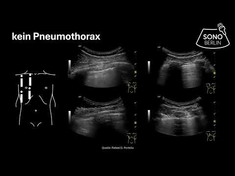 Ultraschall Pneumothorax - 3-Schritte-Ausschluss inkl. M-Mode