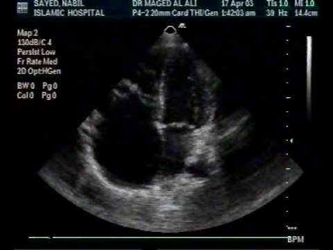 Ebstein's Anomaly In An Adult (2/2)