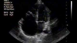 preview picture of video 'echocardiogram:Ebstein anomaly apical 4chamber view'